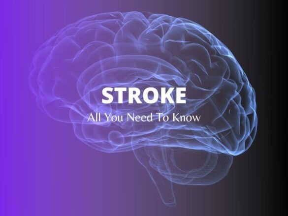 Brain stroke All You Need To Know
