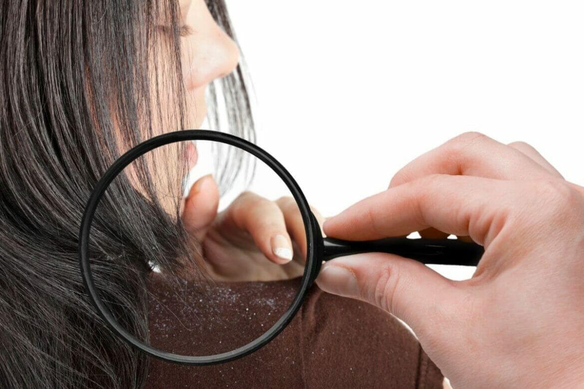 Image of a hand with magnifying lens and a girl with dandruff flakes on shoulder