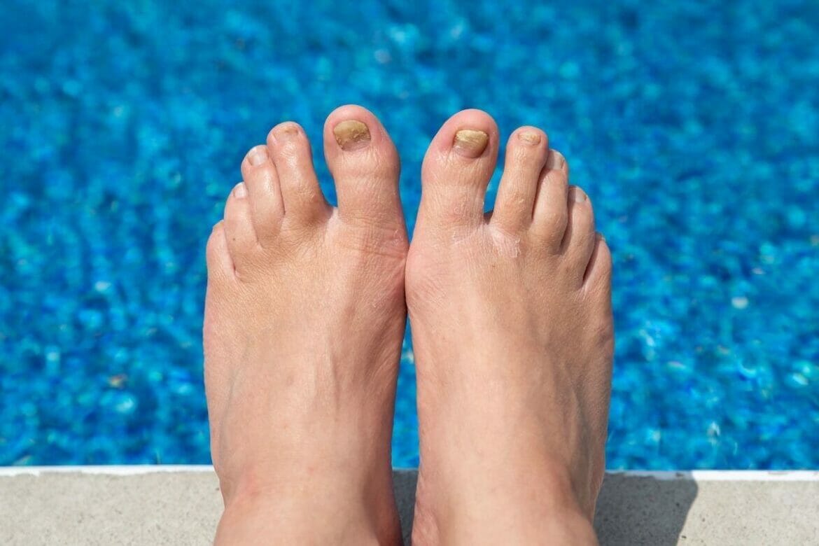 Legs with toenail fungus in a swimming pool background; neem oil use for toenail fungus
