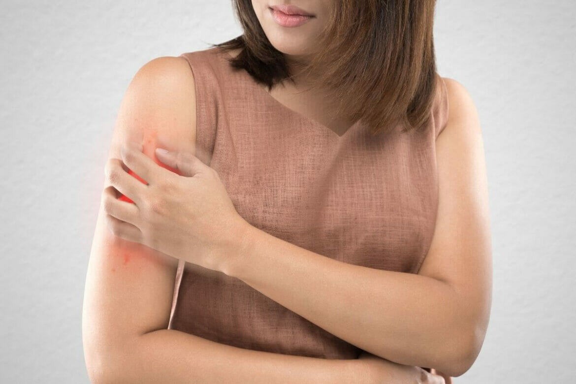 Image of a girl with Psoriasis symptoms