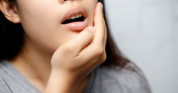 Woman with canker sores aka mouth ulcers pain