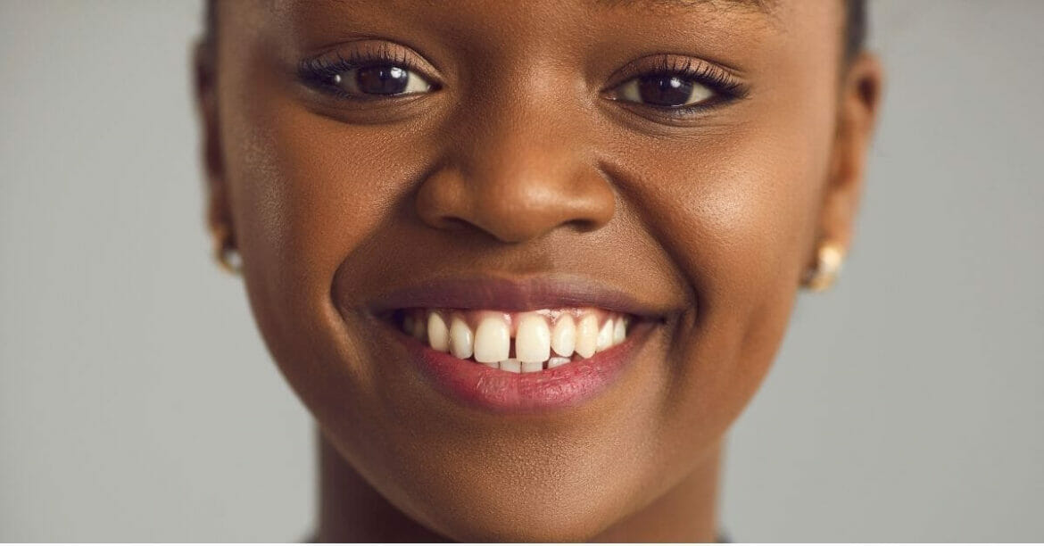 A girl with gapped teeth (diastema)