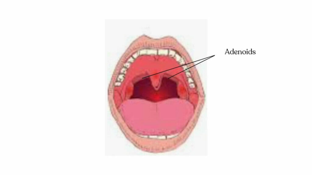 Adenoids illustrated