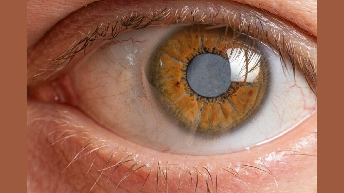 Image of an eye with cataract - knowing the types, symptoms and cause can help prevent the condition from occurring