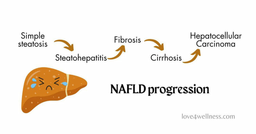 Infographic of NAFLD progression