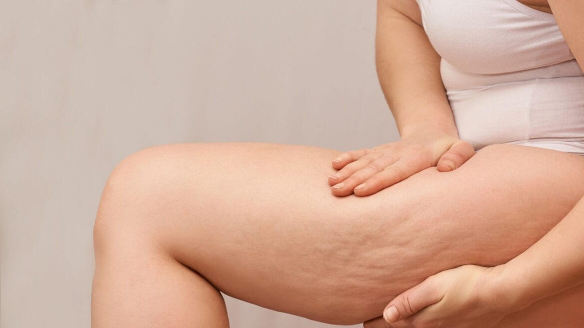Image of a woman's thigh with cellulite