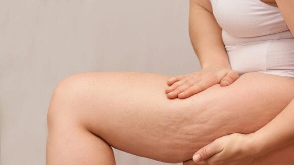 Image of a woman's thigh with cellulite - Natural and home remedies can reduce cellulite to some extent